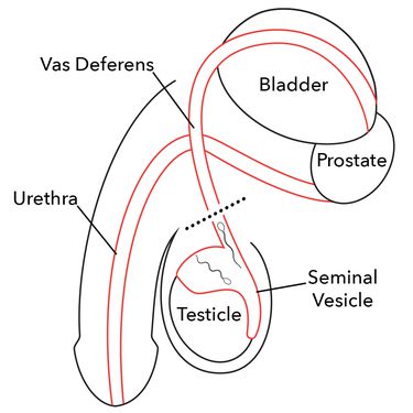 Demonstração da cirurgia vasectomia