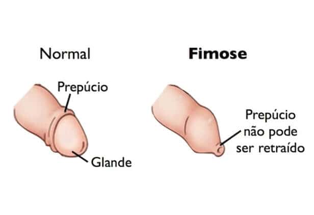 fimose