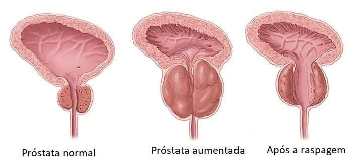 raspagem da prostata