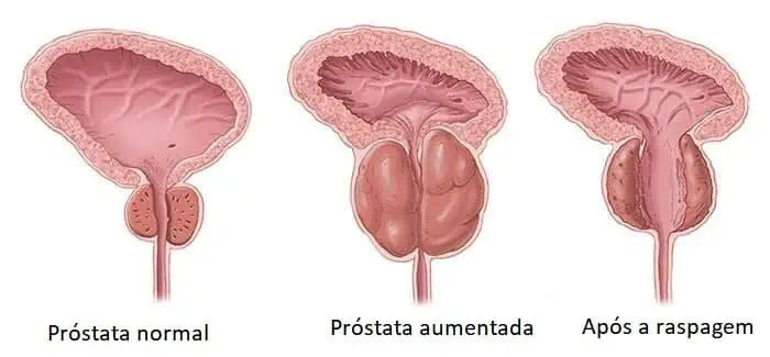 Ilustração médica da raspagem da próstata para tratamento da obstrução urinária e da próstata aumentada