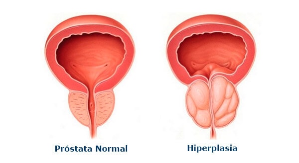 hiperplasia da prostata