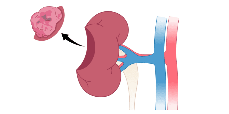 cirurgia de nefrectomia parcial para retirada de parte do rim para tumores, nódulos ou cistos renais