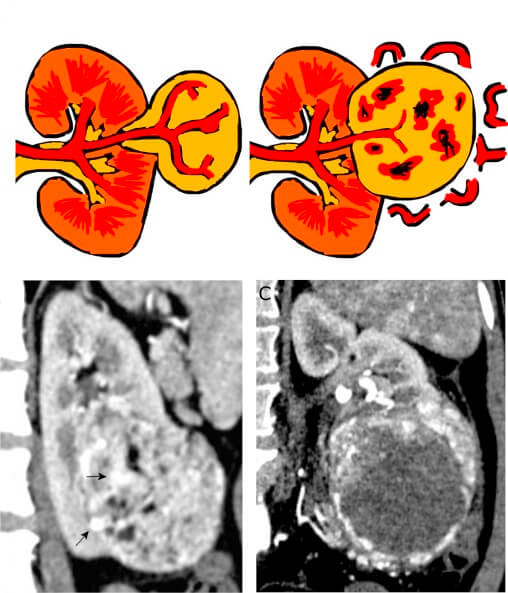 Esquema demonstrando o aspecto do angiomiolipoma e  exame de tomografia com diagnostico de angiomiolipoma