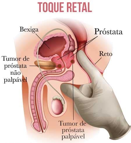 Toque retal da próstata