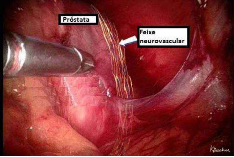 preservação do feixe da ereção na cirurgia de próstata