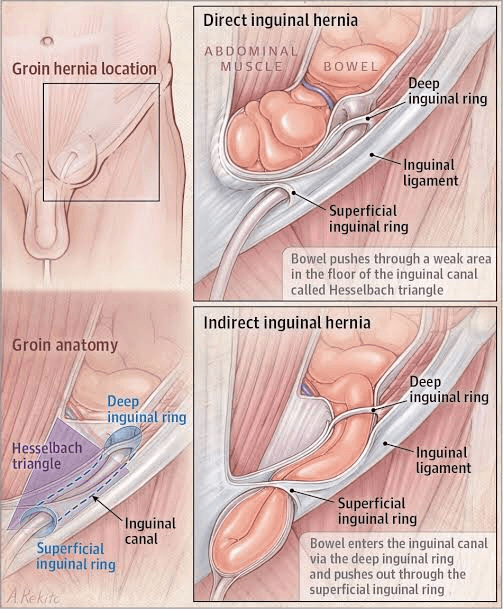 Cuidados necessários após a cirurgia de hérnia inguinal - SBH
