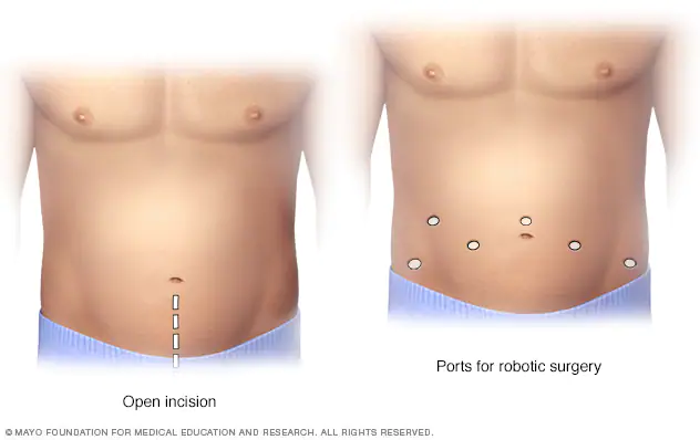 incisões da cirurgia robótica da próstata