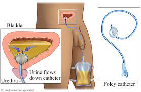 Desenho esquemático ilustrando o funcinamento da sonda vesical de demora.