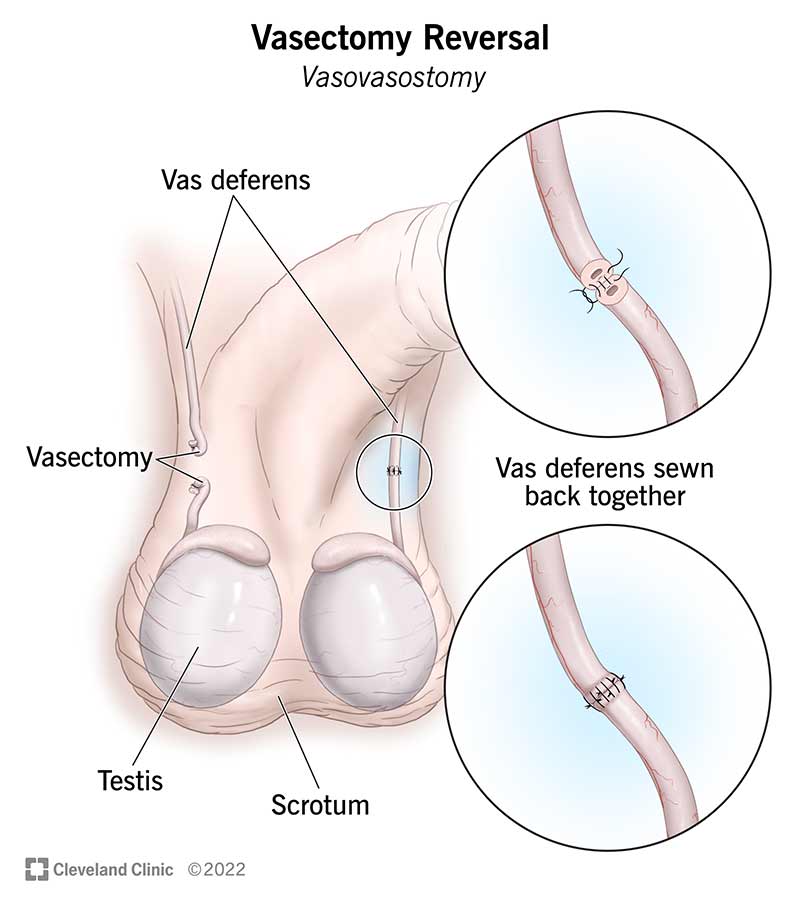 Reversão de vasectomia por vasovasostomia.