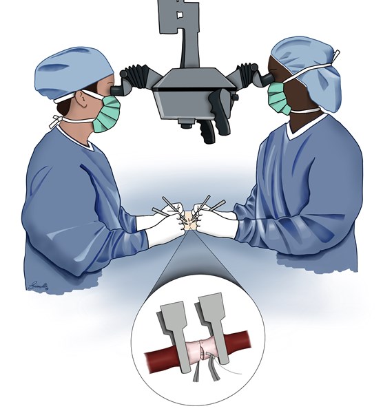 Microcirurgia para reversão de vasectomia.