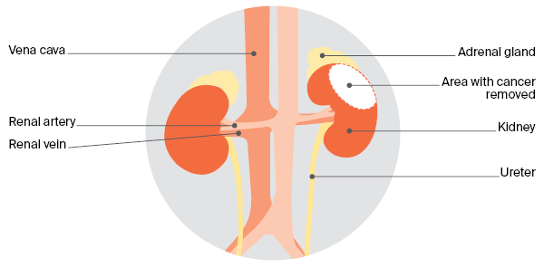 Desenho esquemático e simplificado da anatomia dos rins e do sistema urinário. À direita temos um rim submetido à nefrectomia parcial