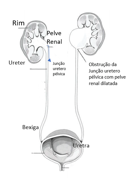 Figura demonstrando a junção ureteropélvica normal à esquerda e , à direita, com estreitamento (estenose) associado com dilatação do sistema coletor.