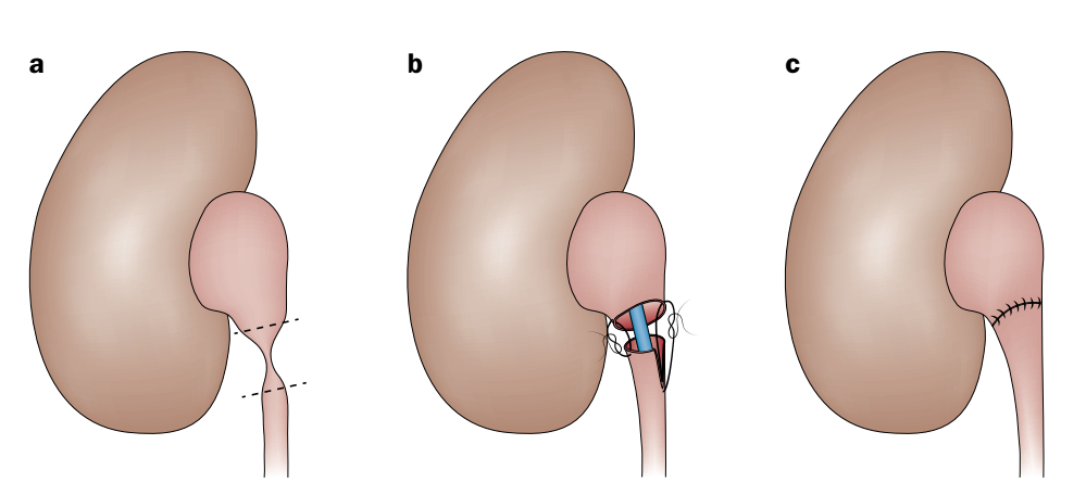 Ilustração demonstrando o passo à passo da Pieloplastia: (a) secção da área afetada / (b) reconstrução com sutura / (c) pieloplastia finalizada.