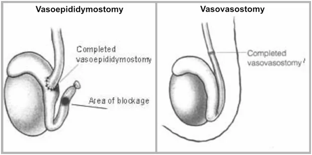 Vasoepididimostomia e vasovasostomia para reversão de vasectomia.