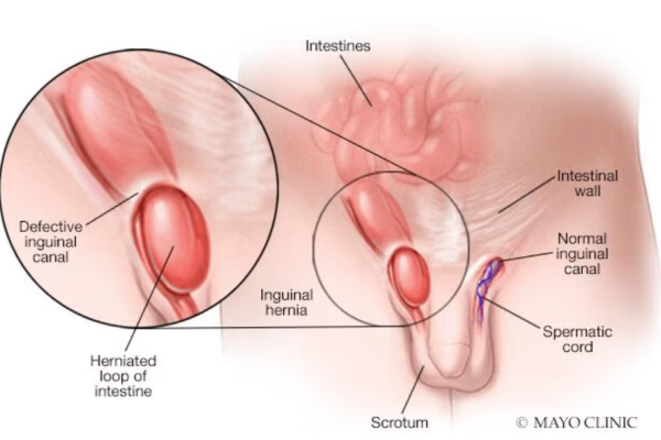 inguinal-hernia-1